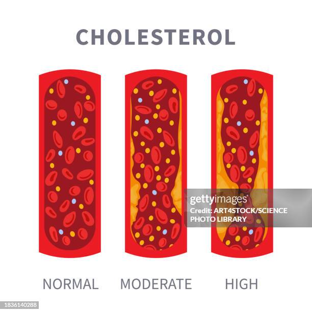 cholesterol levels, conceptual illustration - atherosklerose stock-grafiken, -clipart, -cartoons und -symbole