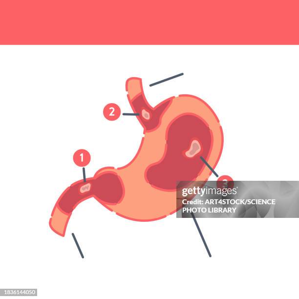 peptic ulcer, conceptual illustration - endoscopy stock illustrations