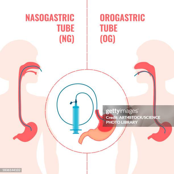 enteral feeding tubes, conceptual illustration - intubation stock illustrations