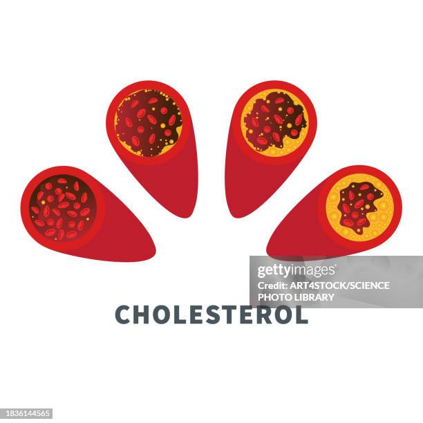 atherosclerosis, conceptual illustration - high density lipoprotein stock illustrations