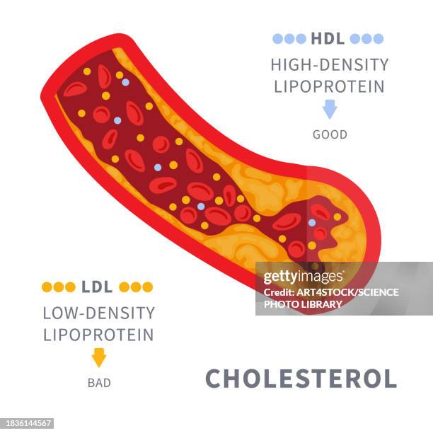 blocked artery, conceptual illustration - ldl cholesterol stock illustrations