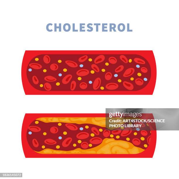 artery health, conceptual illustration - arteriosklerose stock-grafiken, -clipart, -cartoons und -symbole