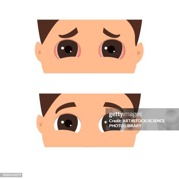 conjunctivitis, conceptual illustration - swollen stock illustrations