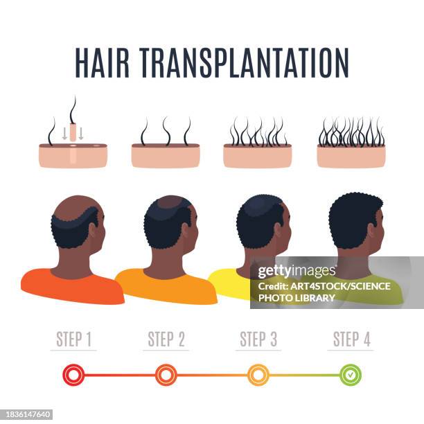 hair transplantation, conceptual illustration - personal hygiene product stock illustrations