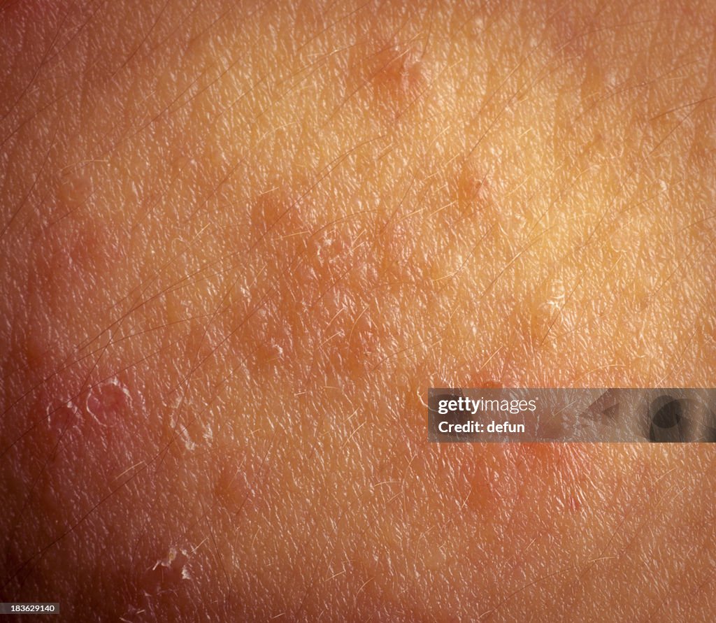 Atopic Dermatitis Skin Rashes Eczema Atopic Dermatitis Symptom Skin Texture High-Res Stock Photo ...