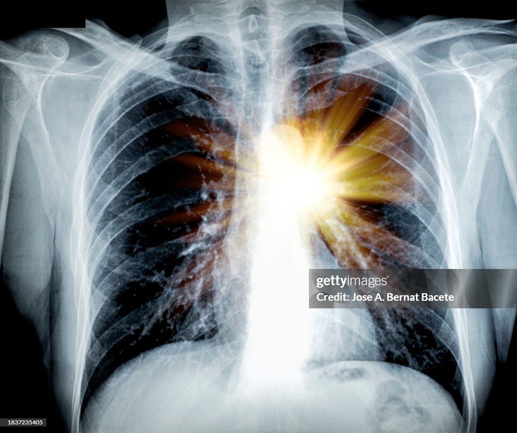 X-ray image of the chest of an adult man with severe pain coming from his heart.