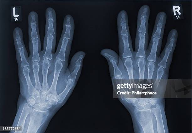 x-ray of a left hand and right hand - xray images stock pictures, royalty-free photos & images