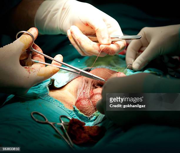 circumcision surgery. - piemel kind stockfoto's en -beelden