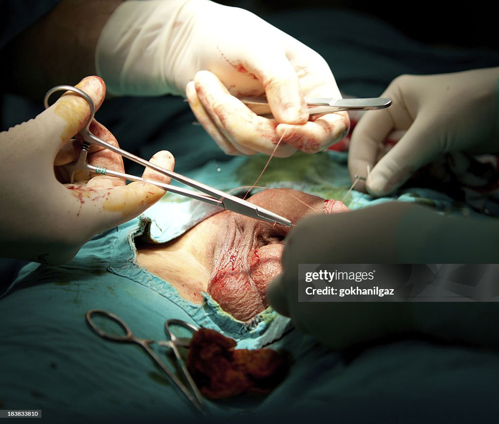 Cirurgia mutilação genital.