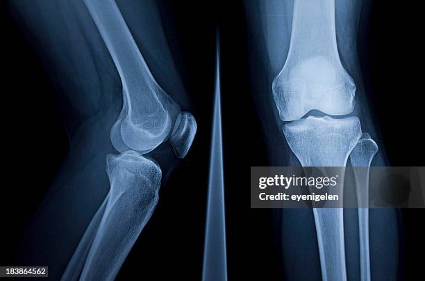 x-ray - scheenbeen bot in het been stockfoto's en -beelden