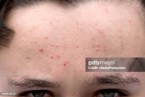 teenage skin problems - pimple stockfoto's en -beelden