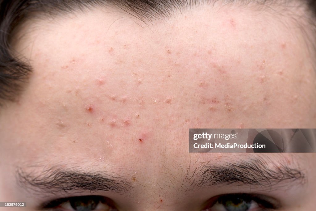 Students Skin Problems Teenage Skin Problems High-Res Stock Photo - Getty Images