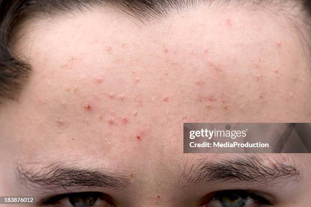 teenage skin problems - pimple stock pictures, royalty-free photos & images