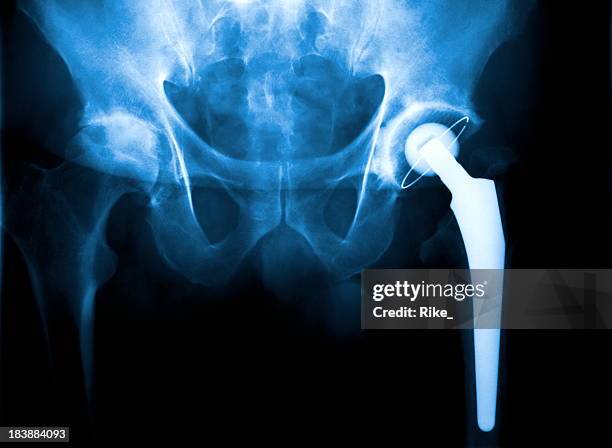 an x ray of a hip joint problem - hip replacement stock pictures, royalty-free photos & images