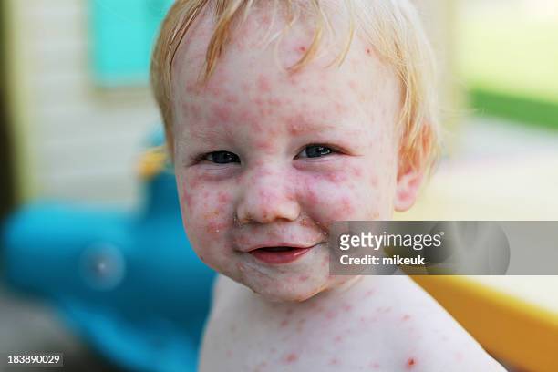 junge mit huhn pocken - chickenpox stock-fotos und bilder
