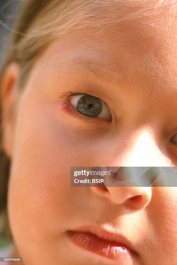 Young Boy with Chalazion