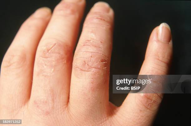 Contact Dermatitis..