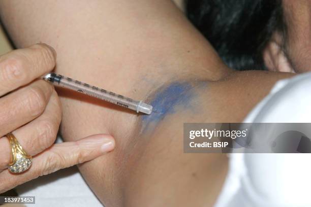 Hyperhidrosis Treatment, Botox Injection In Underarm In Order To Reduce Perspiration.
