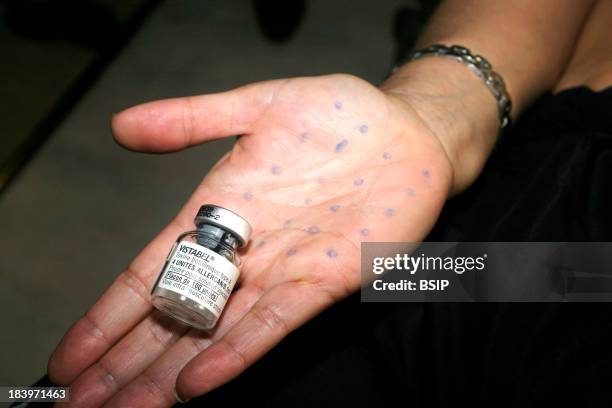 Hyperhidrosis Treatment, Botox Injection In Underarm In Order To Reduce Perspiration.