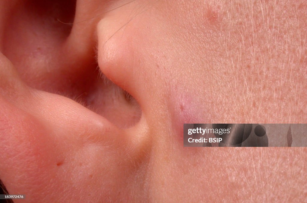 Sebaceous Cyst