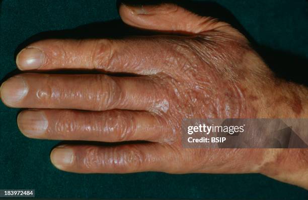 Kaposis Disease.