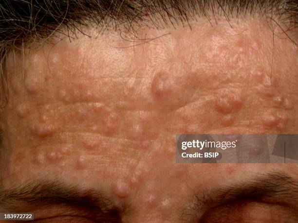 Genodermatosis Genodermatosis Photos and Premium High Res Pictures - Getty Images