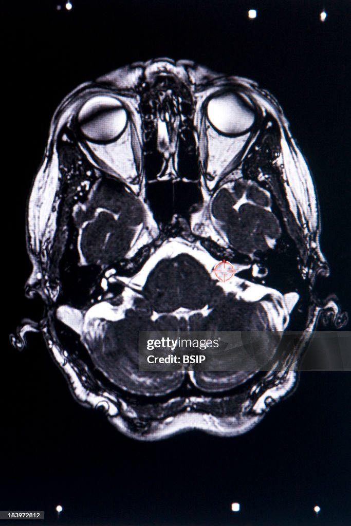 Acoustic Neuroma, Mri
