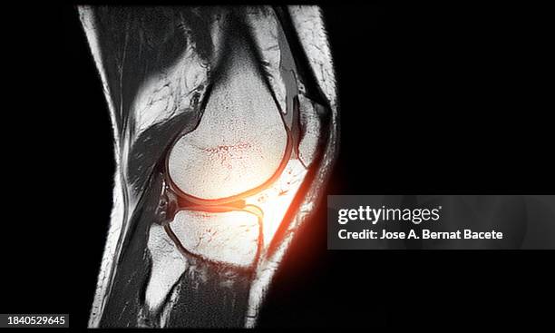 magnetic resonance imaging mri knee with pain simulation on a black background. - kraakbeen stockfoto's en -beelden