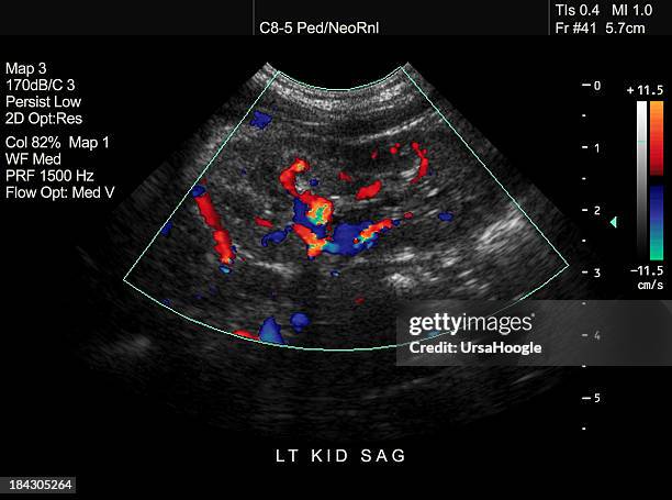 doppler ultraschall von pediatric kidney - urologie stock-fotos und bilder