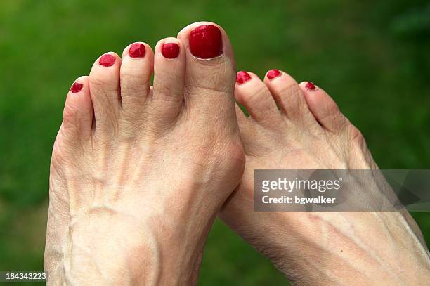feet with bunions - hallux valgus stock pictures, royalty-free photos & images