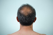 The back view of a man's head who is balding