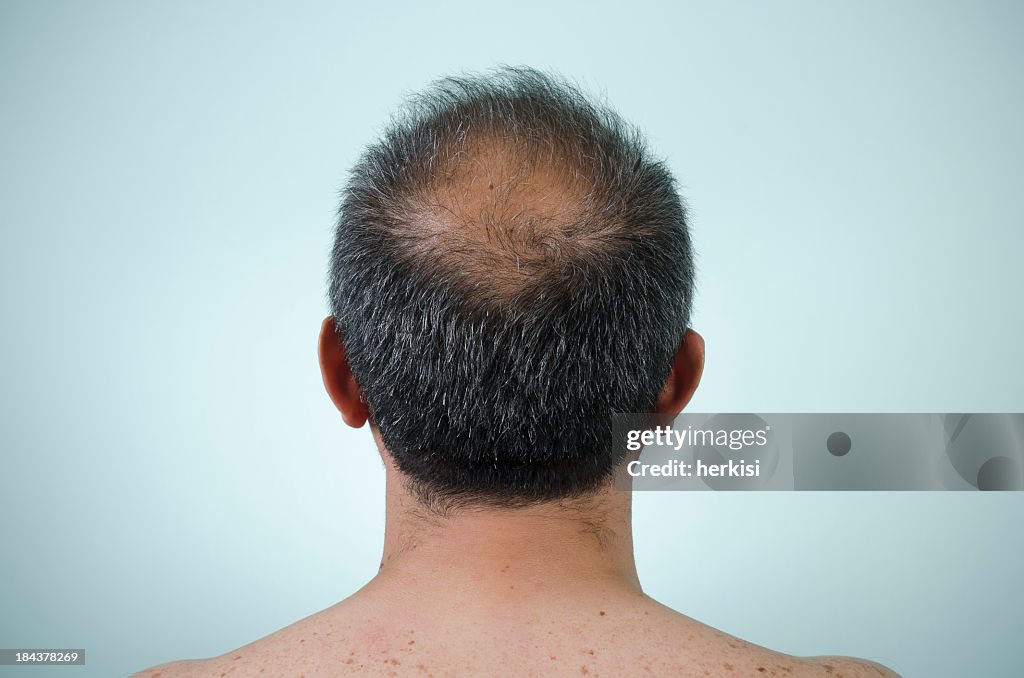 The back view of a man's head who is balding