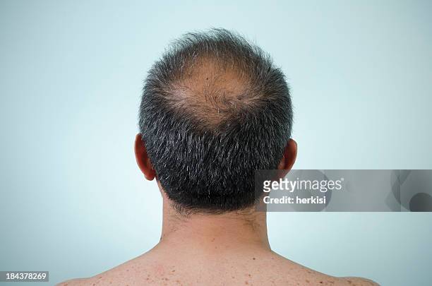 the back view of a man's head who is balding - hair loss stock pictures, royalty-free photos & images