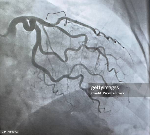 mri scan of veins around the heart - menselijke slagader stockfoto's en -beelden