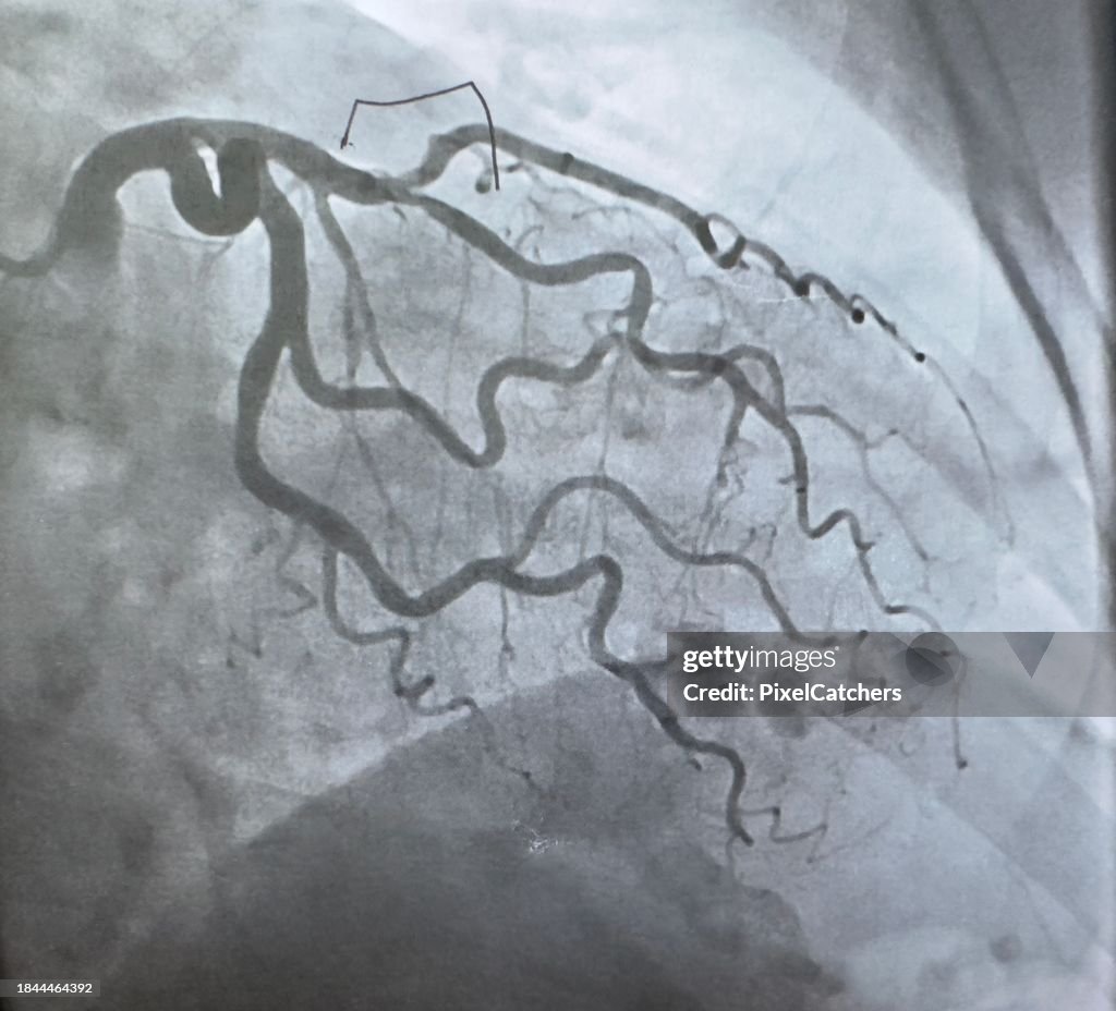 MRI scan of veins around the heart
