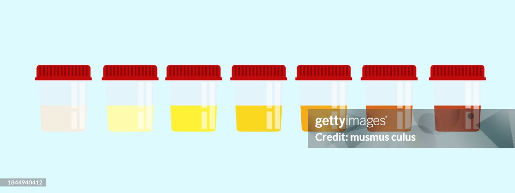 Test cups showing the change in urine color depending on the amount of urea