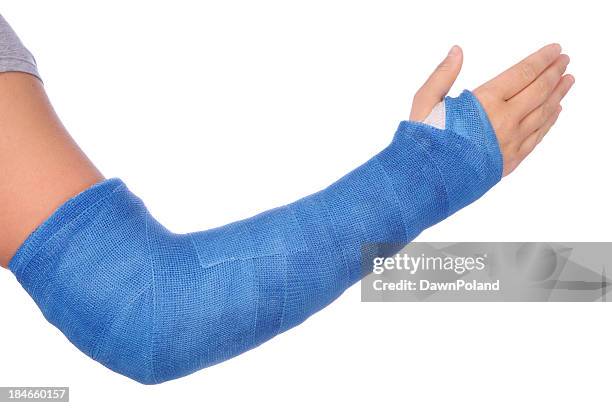broken arm - blue arm cast stock pictures, royalty-free photos & images