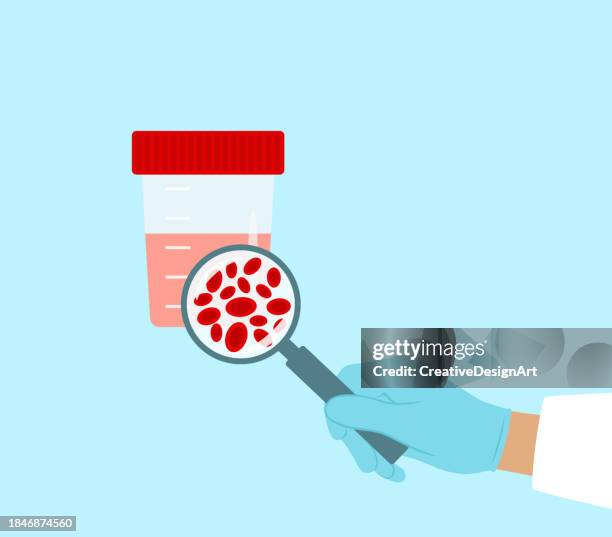 stockillustraties, clipart, cartoons en iconen met doctor examining urinary sample with hematuria. magnifying glass with close-up view of red blood cells - glomerulonefritis