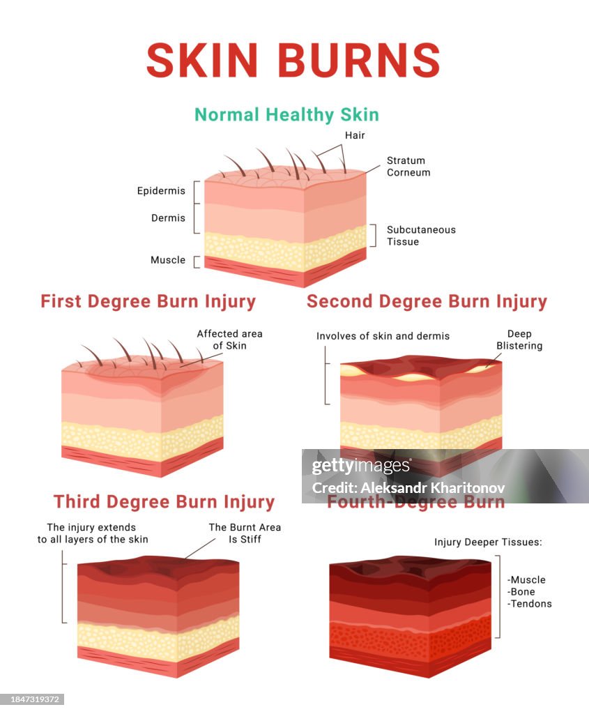 Skin Burn Classification Infographic Medical Educational Scheme Poster