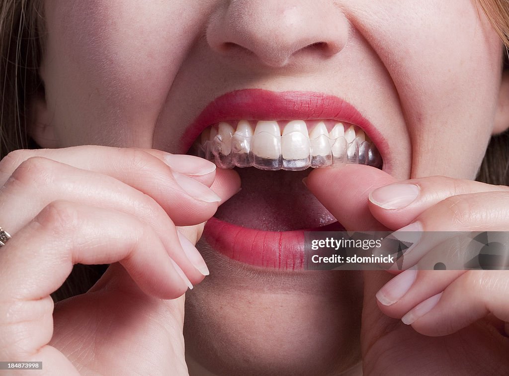 Mulher colocando plástico Retainer dentário com dentes