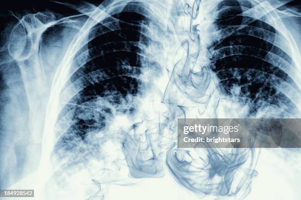 humo visibles en la radiografía de tórax imagen - medical x ray fotografías e imágenes de stock