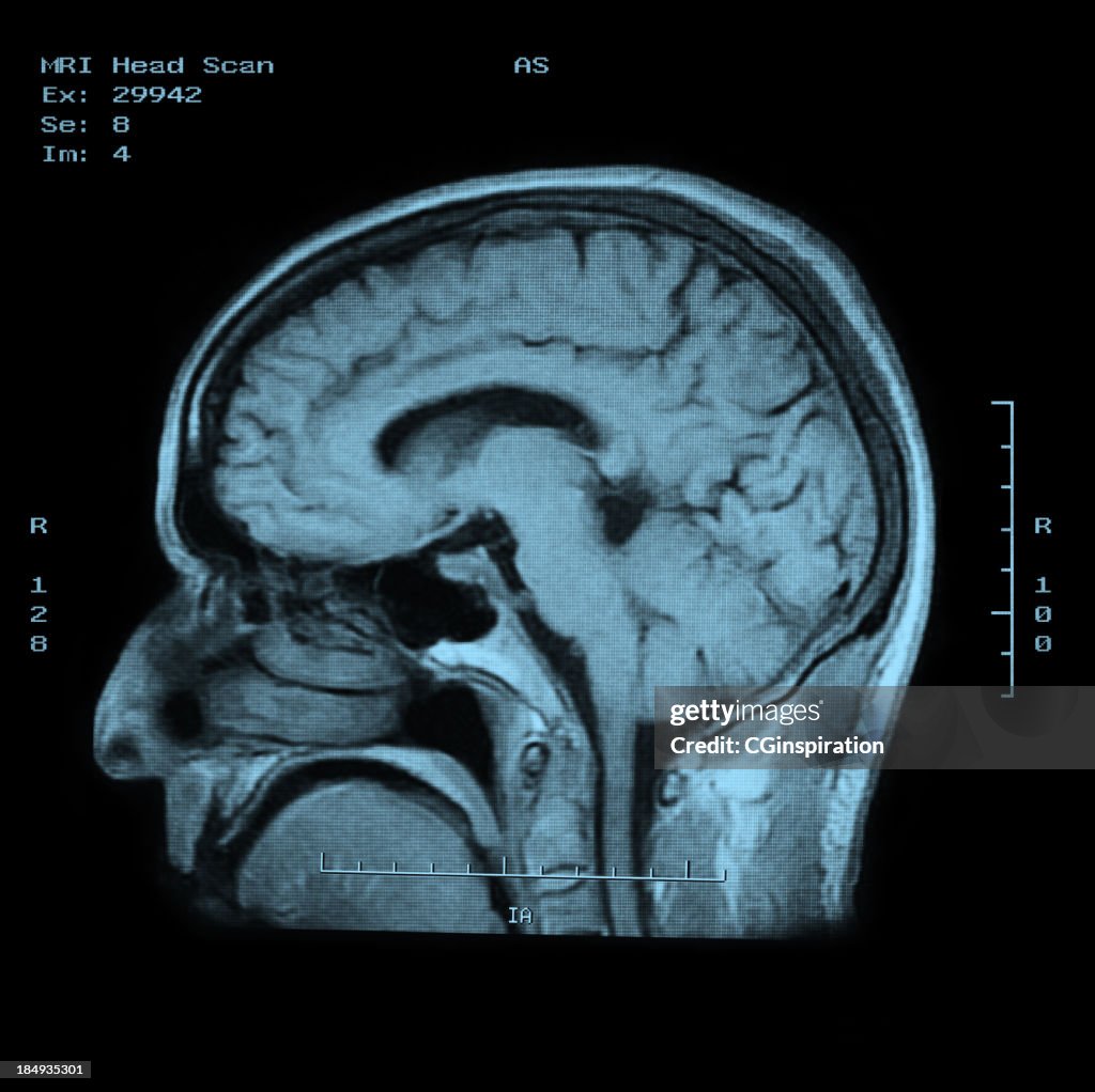 MRI Scan-Kopf-Seitenansicht