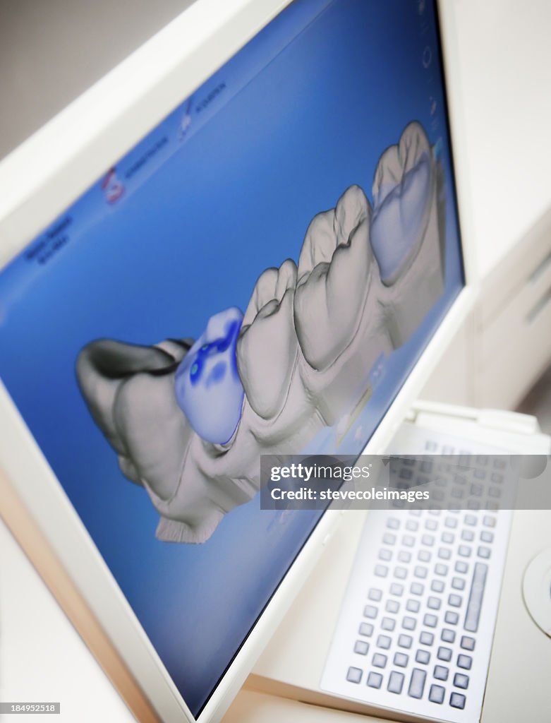 デジタル X 線の人間の歯