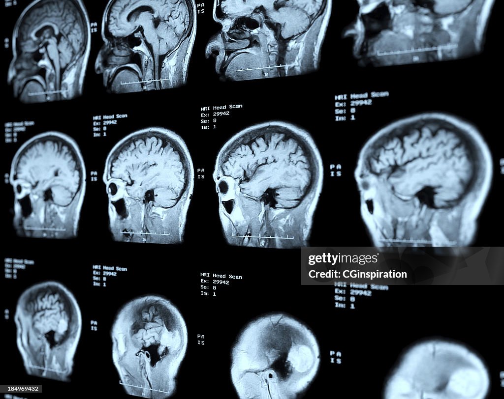 MRI Scan Perspektive Kopf