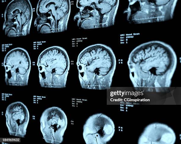 Mri Film Examples Mri Films Photos and Premium High Res Pictures - Getty Images