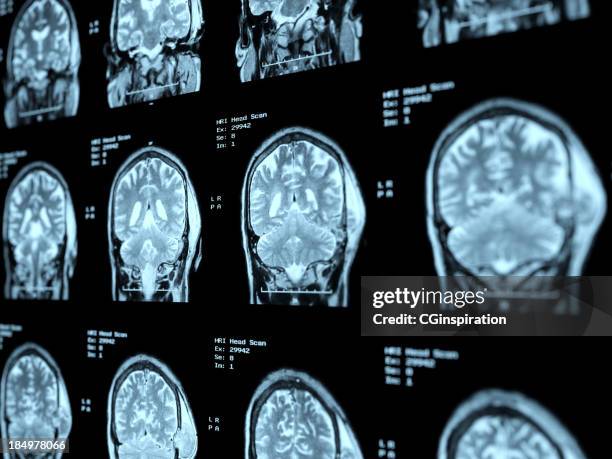 mri head scan perspective - mri scan medische scan stockfoto's en -beelden