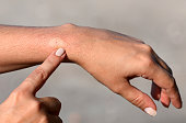 Hand pointing to a persons wrist where they have a bee sting