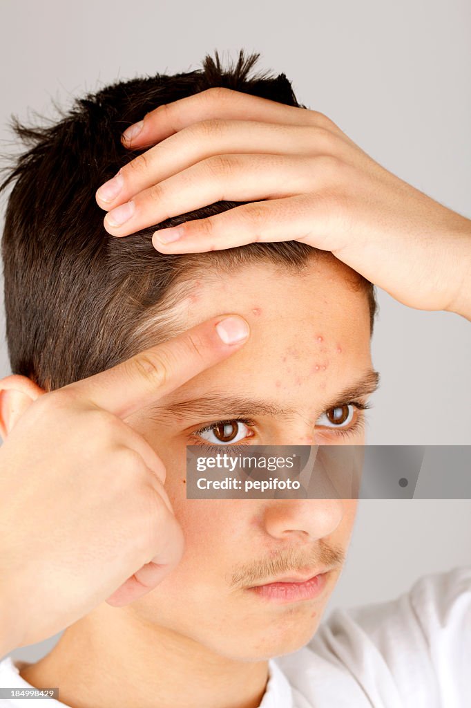 Students Skin Problems Teenage Skin Problems High-Res Stock Photo - Getty Images