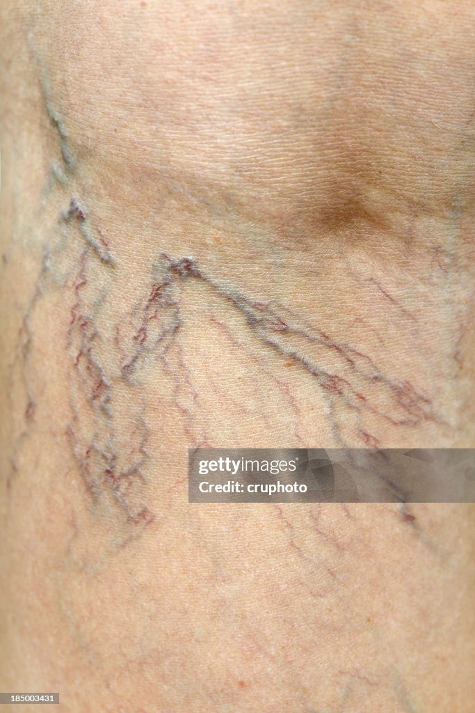 Close-up of Human Spider Veins on Leg