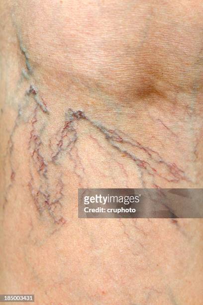 close-up of human spider veins on leg - human limb stock pictures, royalty-free photos & images